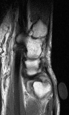 Figure 5 for case Ulnar impingement syndrome